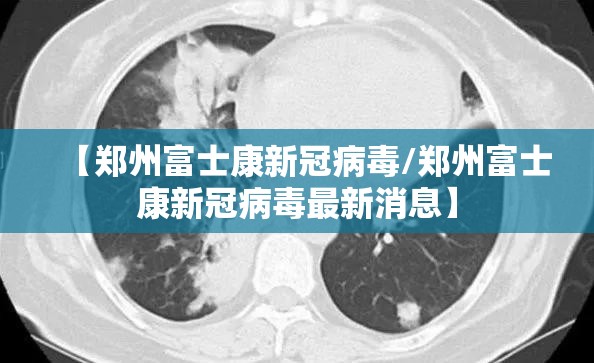 【郑州富士康新冠病毒/郑州富士康新冠病毒最新消息】